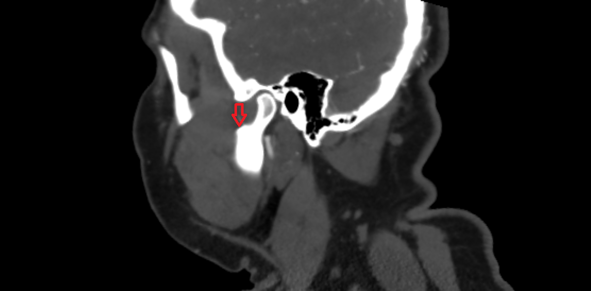 Mandibular notch  CT anatomy labelled image-img-00000-00000_00001