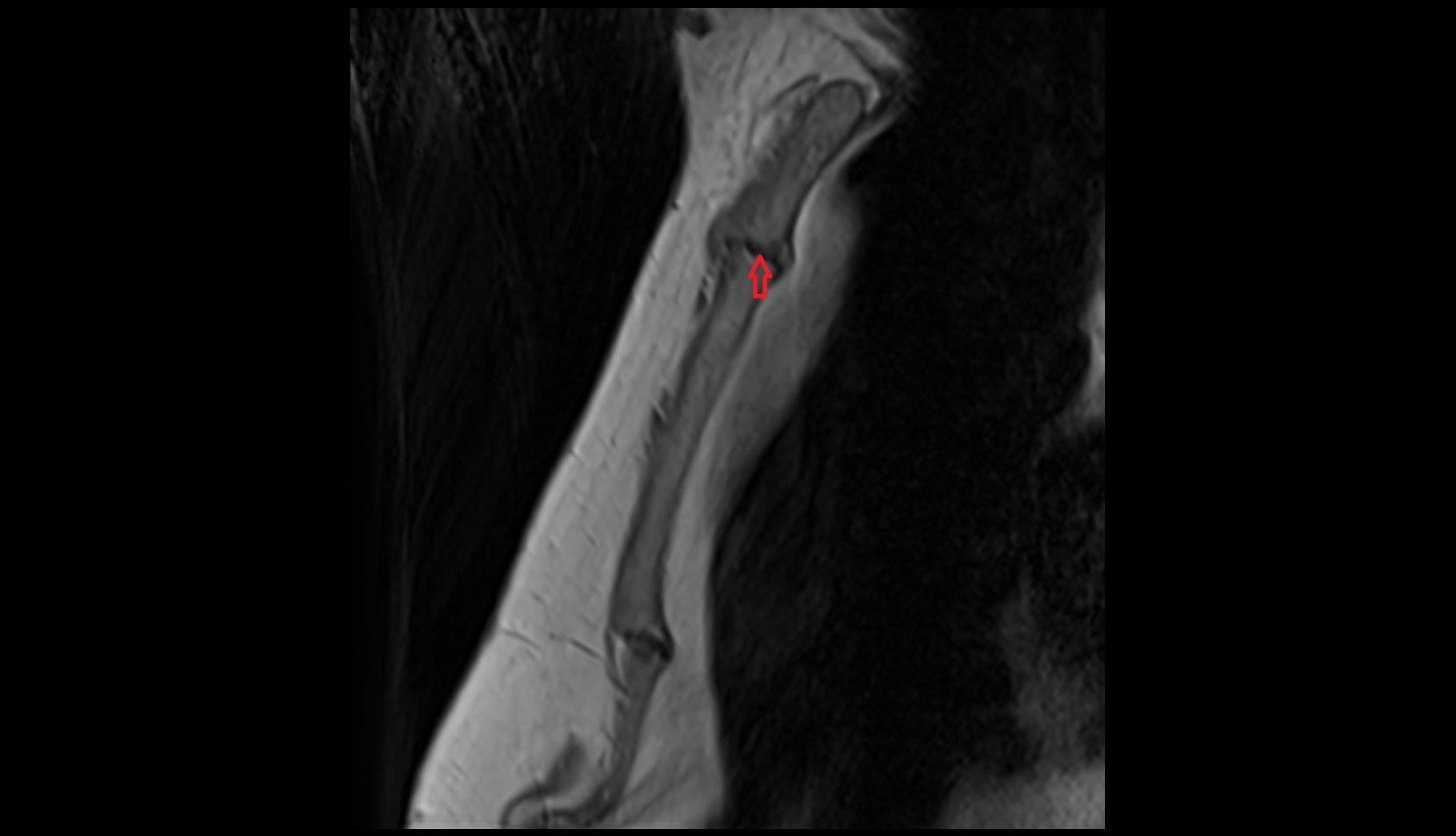 Manubriosternal joint SAG MRI IMAGE