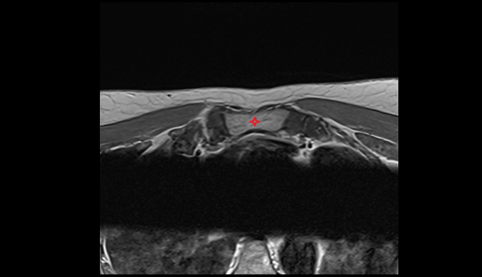 Manubrium of sternum CT AXIAL  image -img-00000-00000