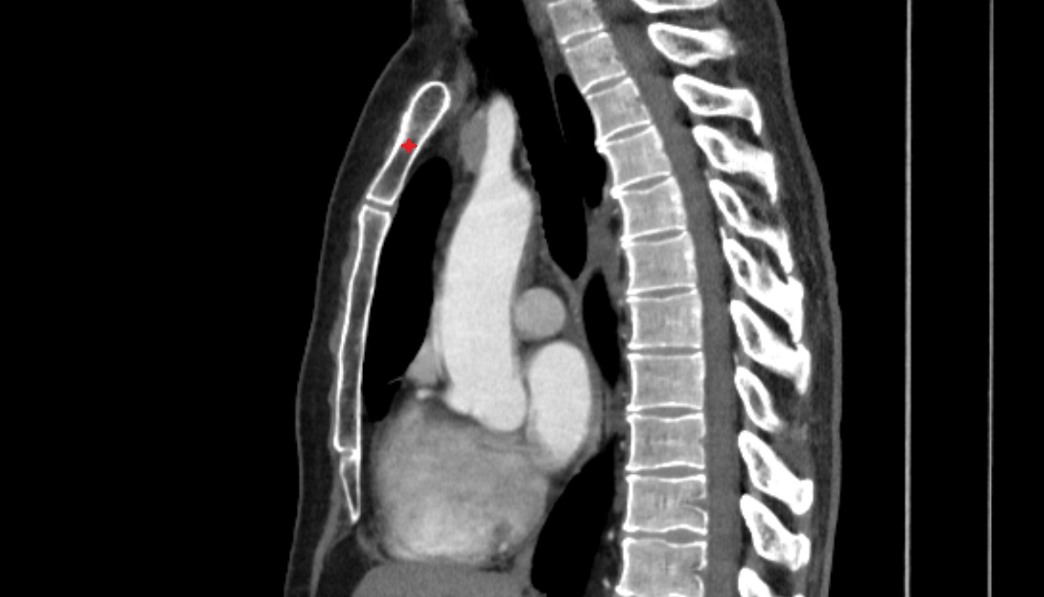 Manubrium of sternum CT SAG  image -img-00000-00000
