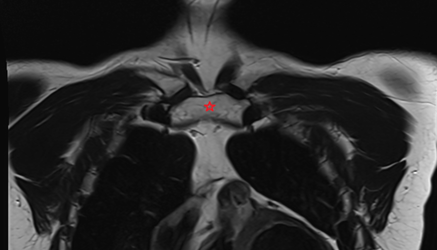 Manubrium of sternum MRI coronal  image -img-00000-00000