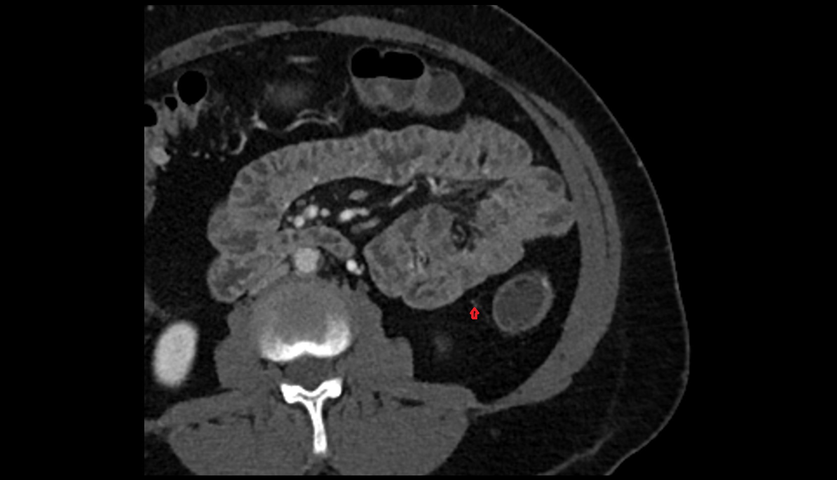 Marginal Artery (of Drummond)