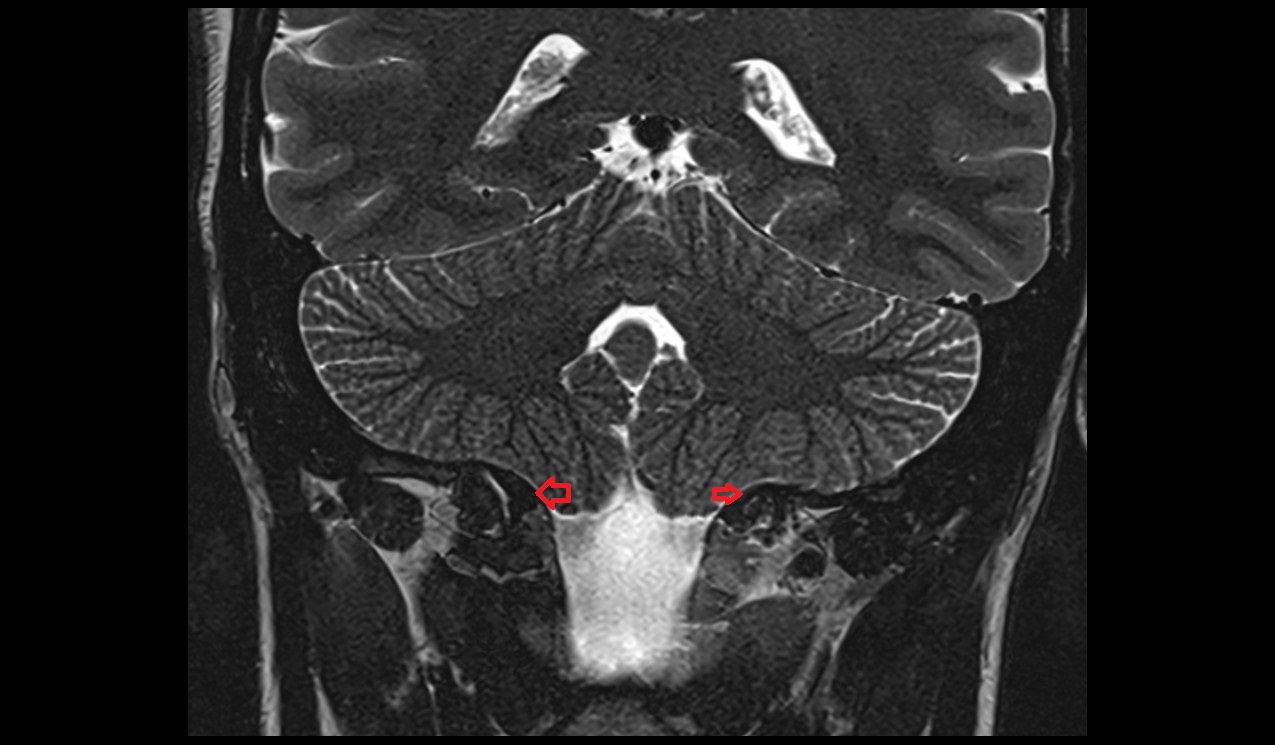 Marginal sinus MRI 3T coronal image