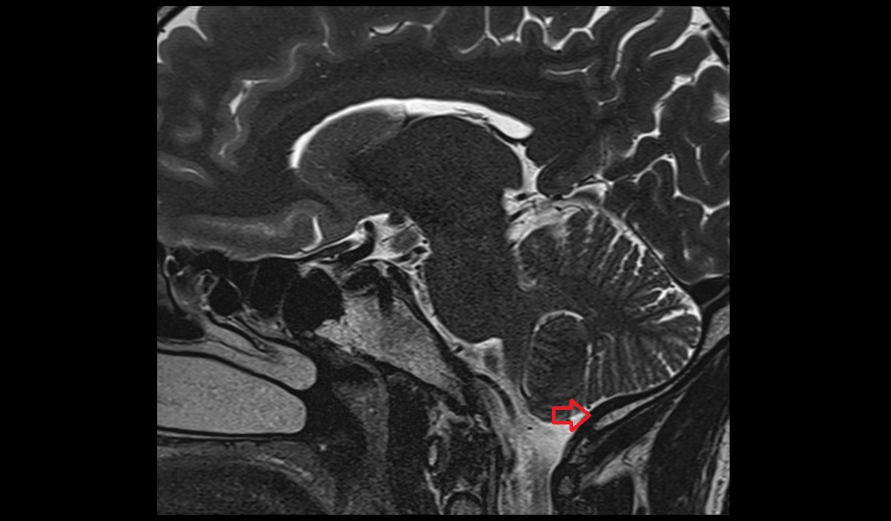 Marginal sinus MRI 3T sagittal image