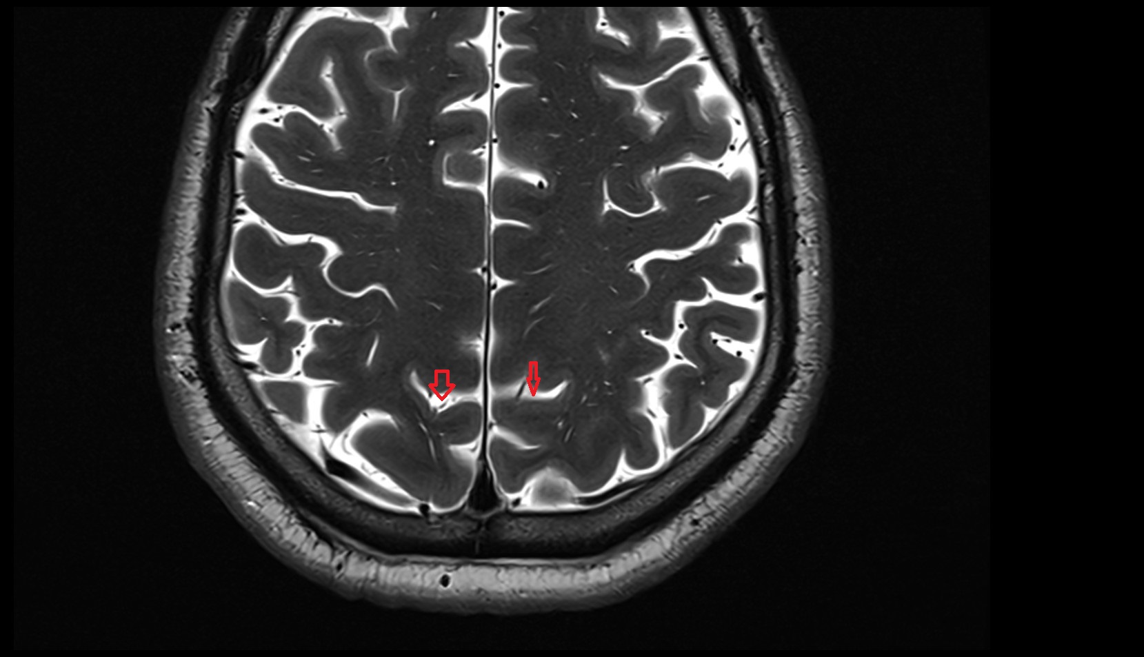 Marginal sulcus MRI 3T axial image