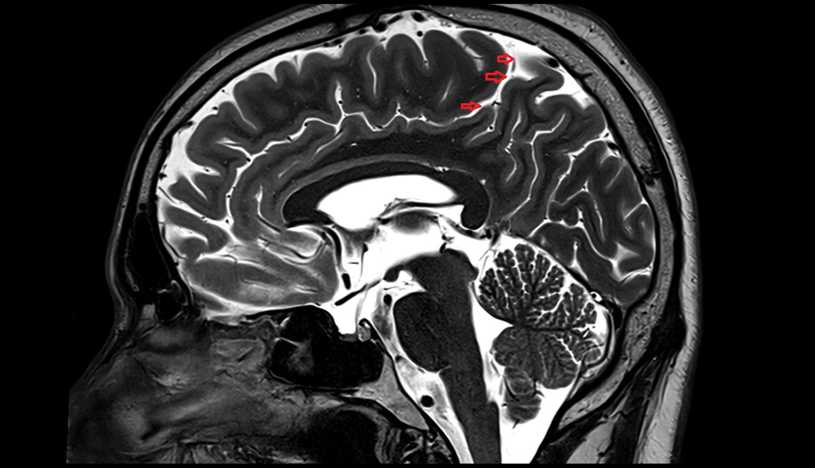 Marginal sulcus MRI 3Tsagittal  image