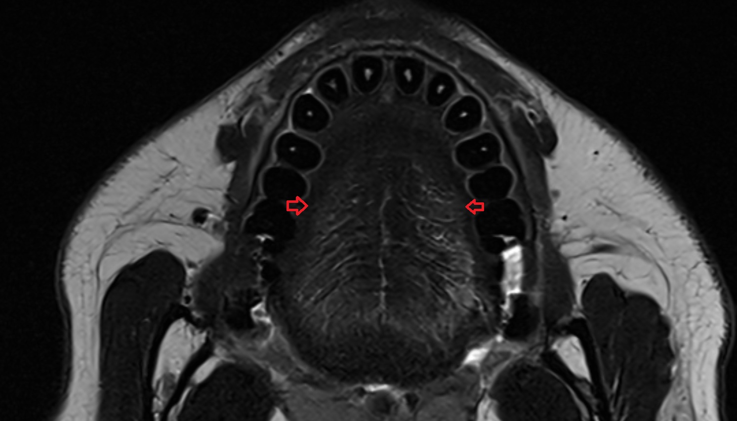 Margin of tongue  mri axial  image -img-00000-00000
