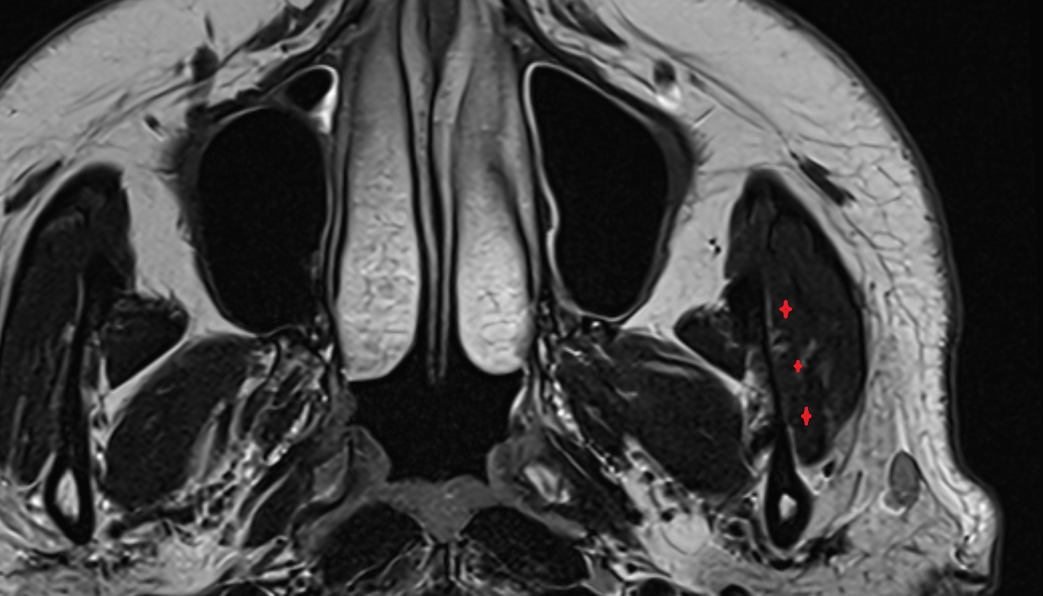 Masseter Muscle (Deep Part) mri axial image -img-00000-00000