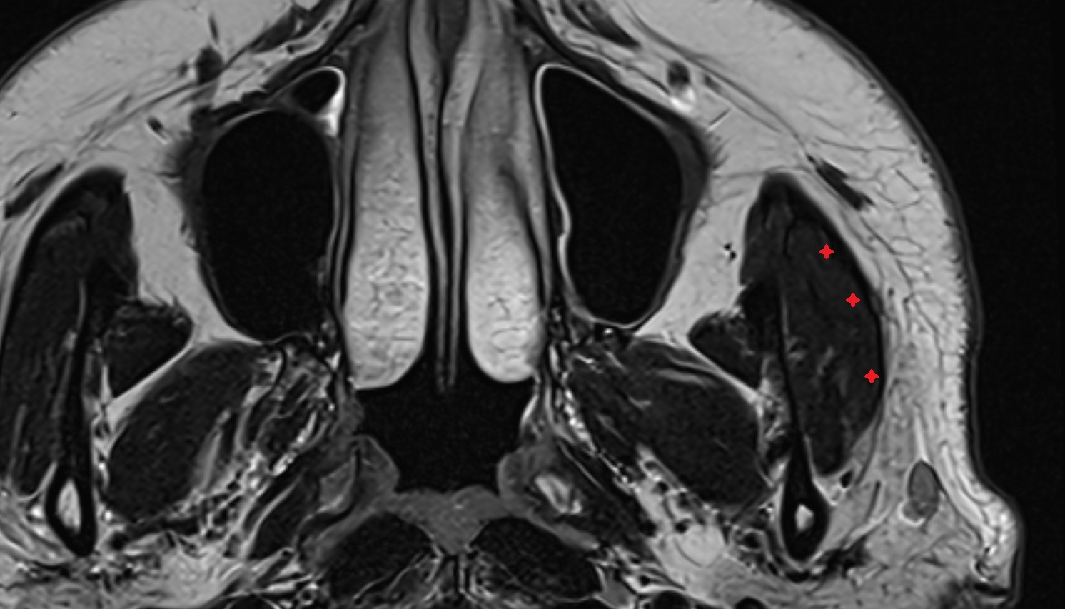 Masseter Muscle (Superficial Part)  mri axial image -img-00000-00000
