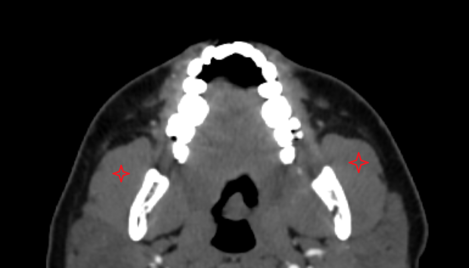 Masseter muscle  CT axial  image-img-00000-00000