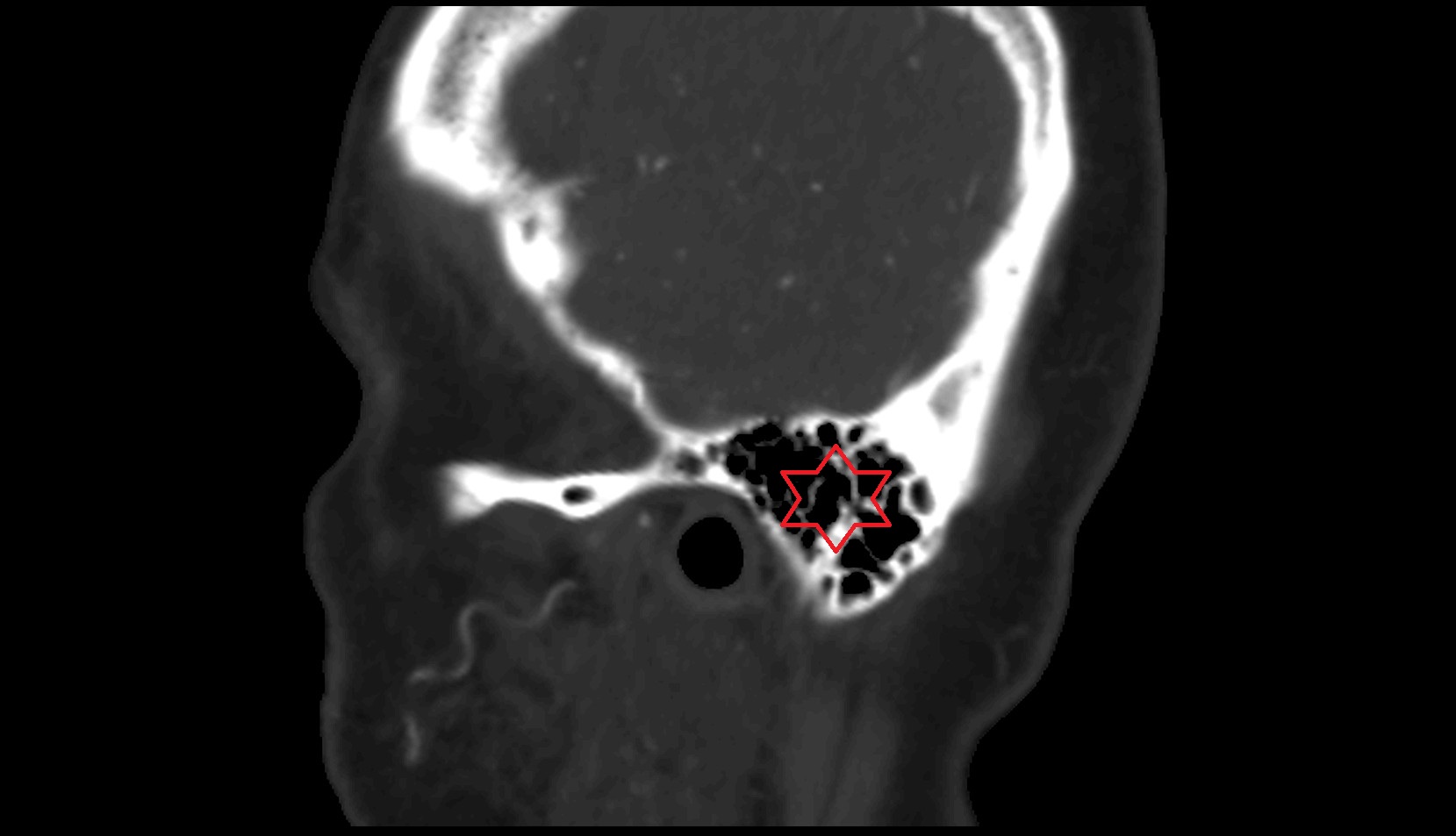 Mastoid air cells CT