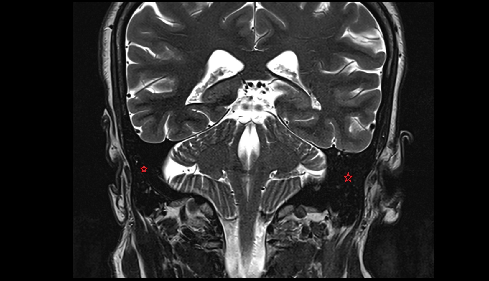 Mastoid cells mri CORONAL IMAGE