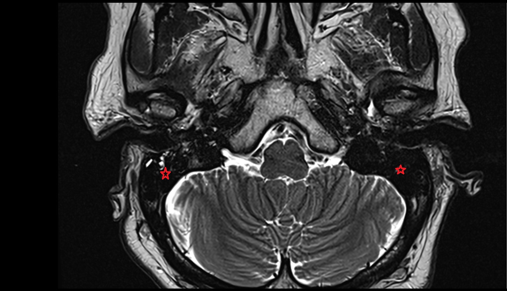 Mastoid cells mri axial image