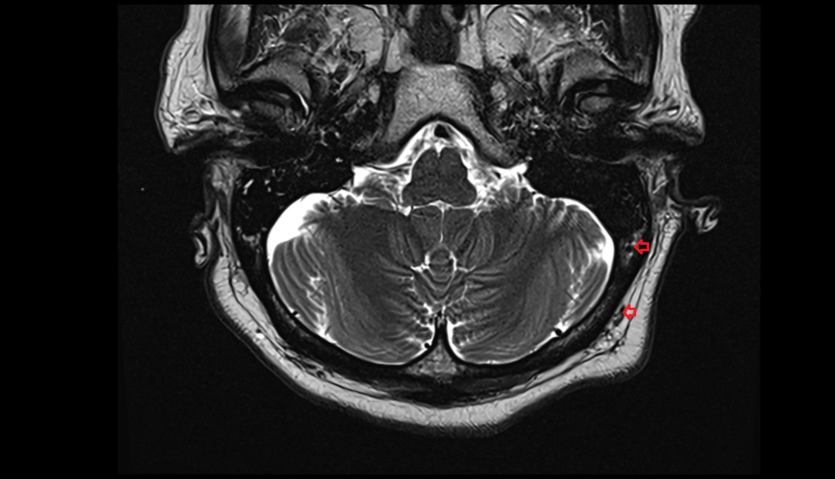 Mastoid emissary vein MRI 3T axial image
