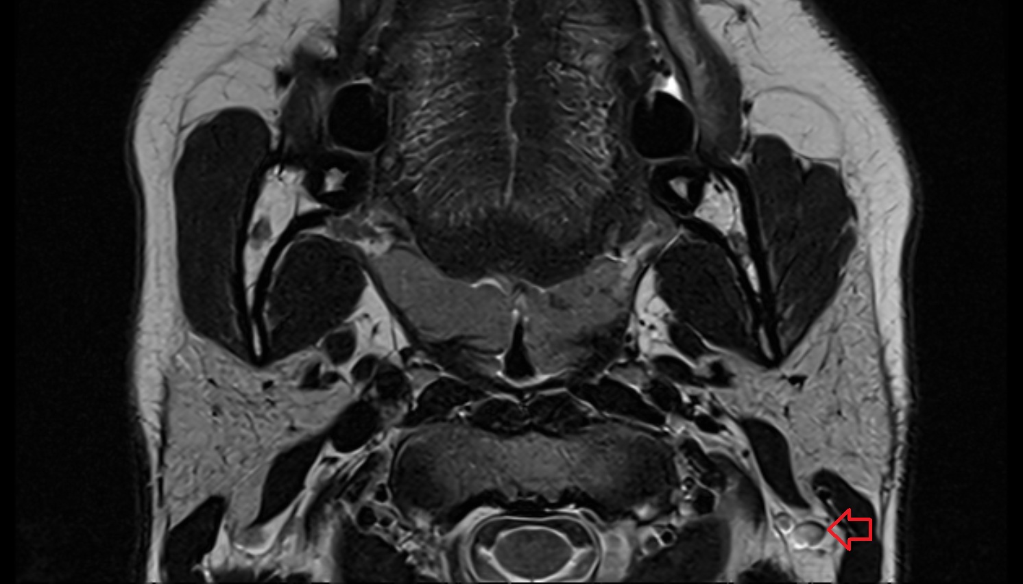 Mastoid lymph nodes  mri axial  image -img-00000-00000