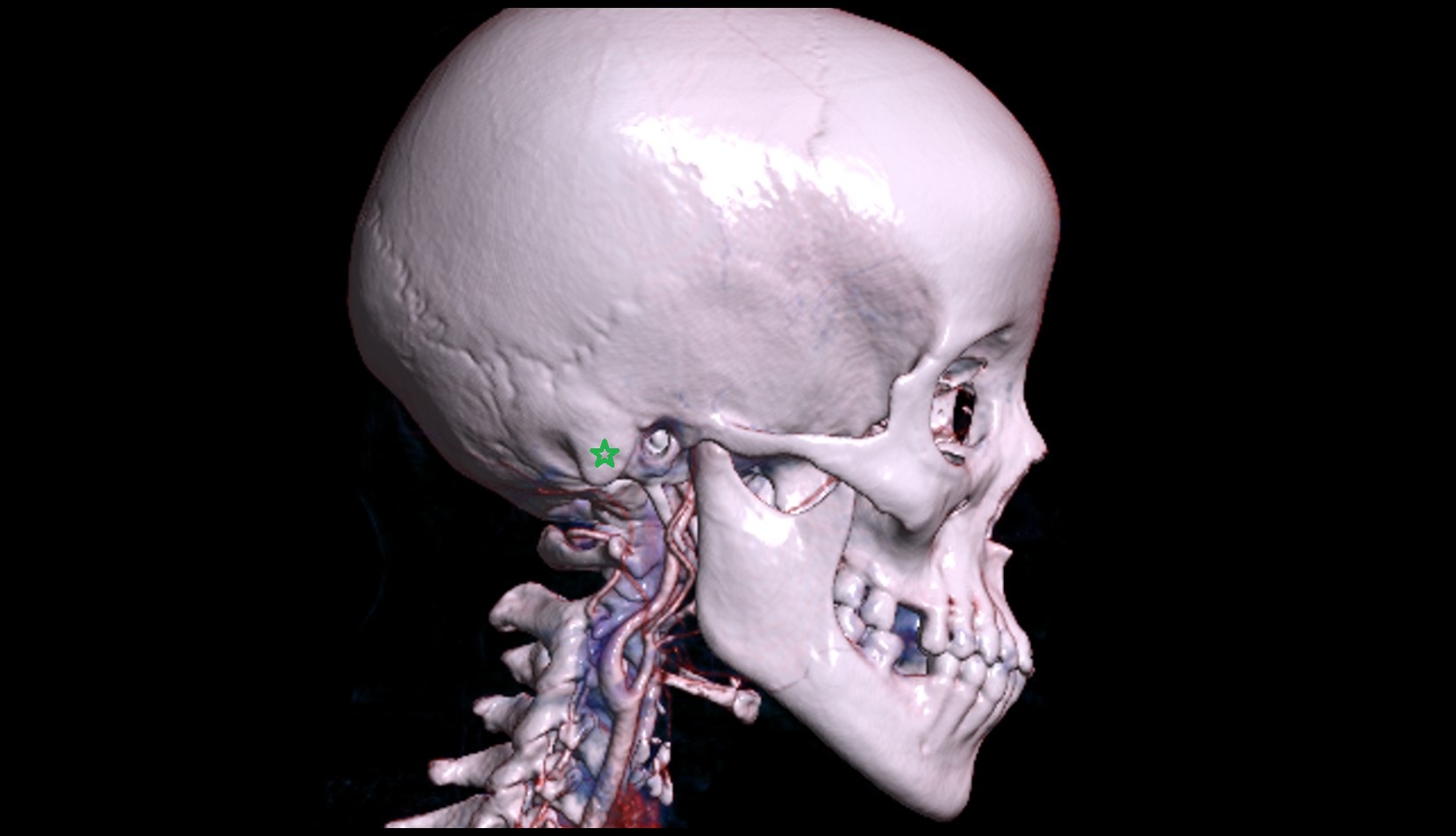 Mastoid process 3d