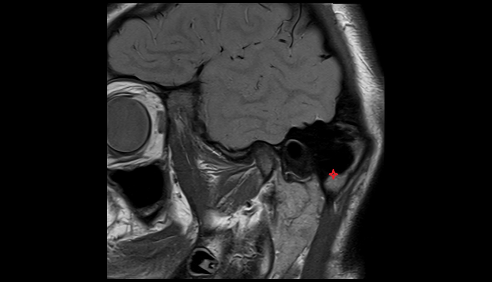 Mastoid process mri image