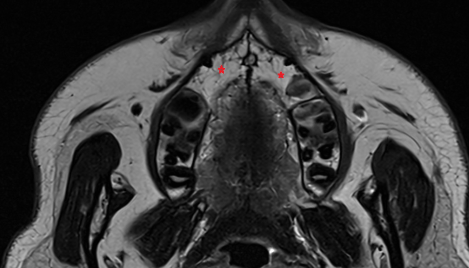 Maxilla  mri axial  image -img-00000-00000