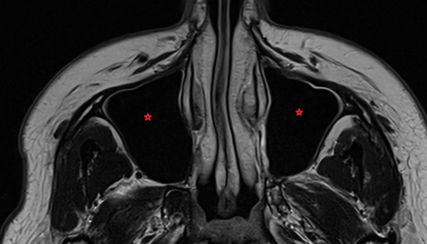 Maxillary Sinus  mri axial  image -img-00000-00000