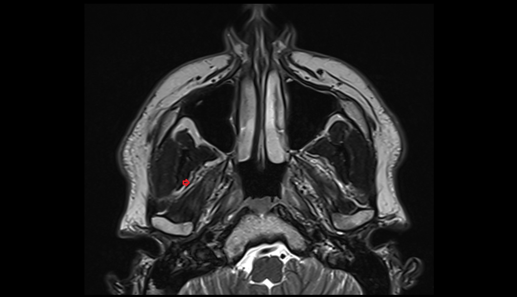 Maxillary artery axial image