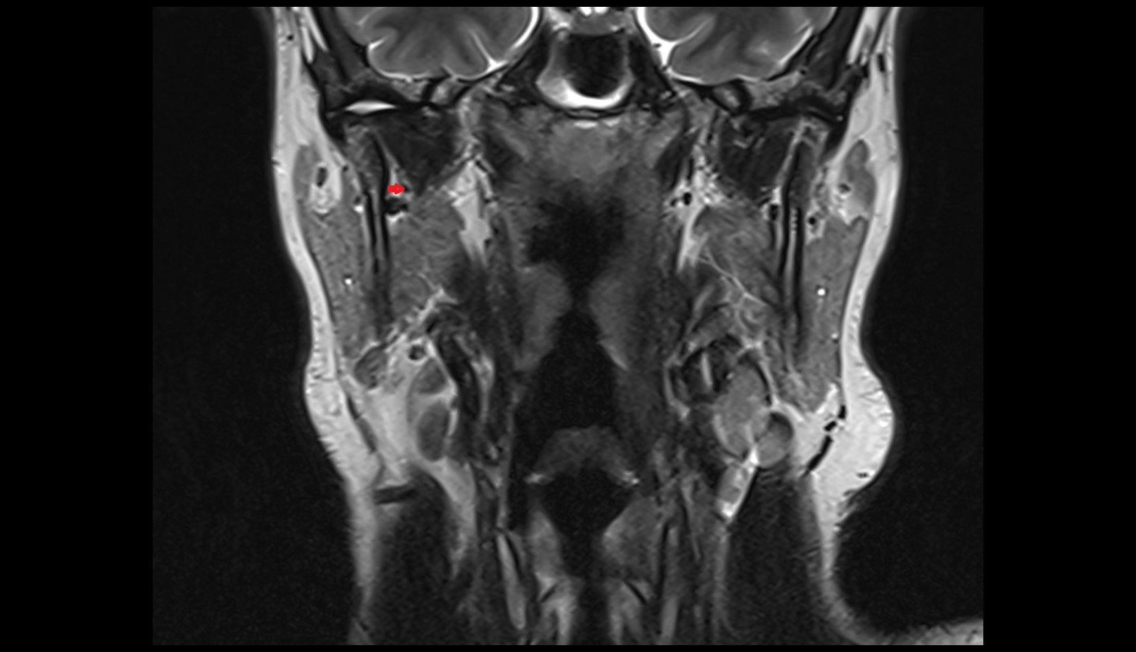 Maxillary artery coronal t2 image