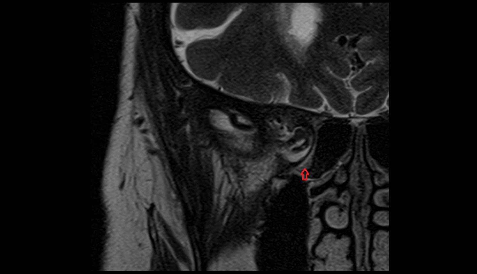 Maxillary nerve mri image
