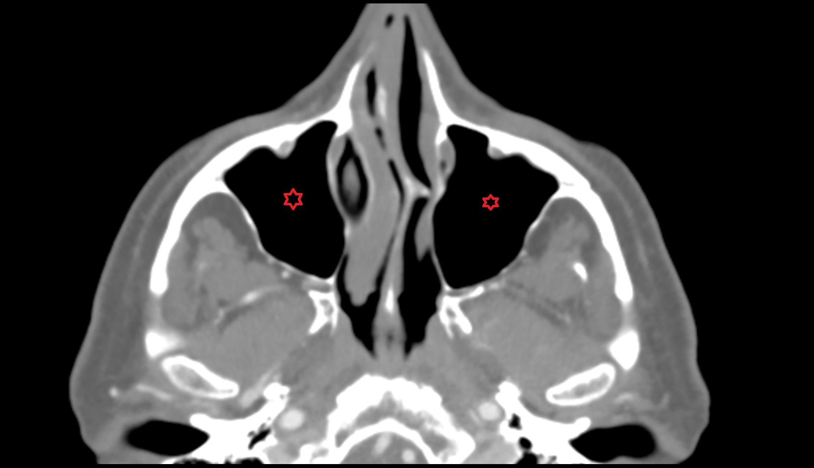Maxillary sinus CT