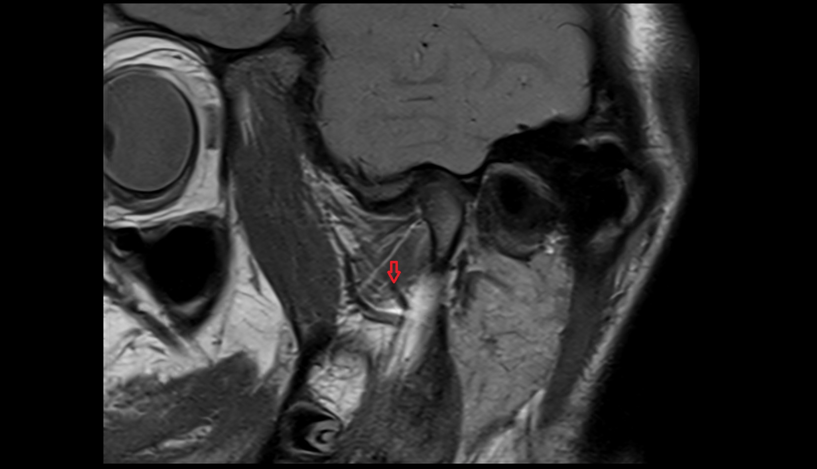 Maxillary veins MRI IMAGE