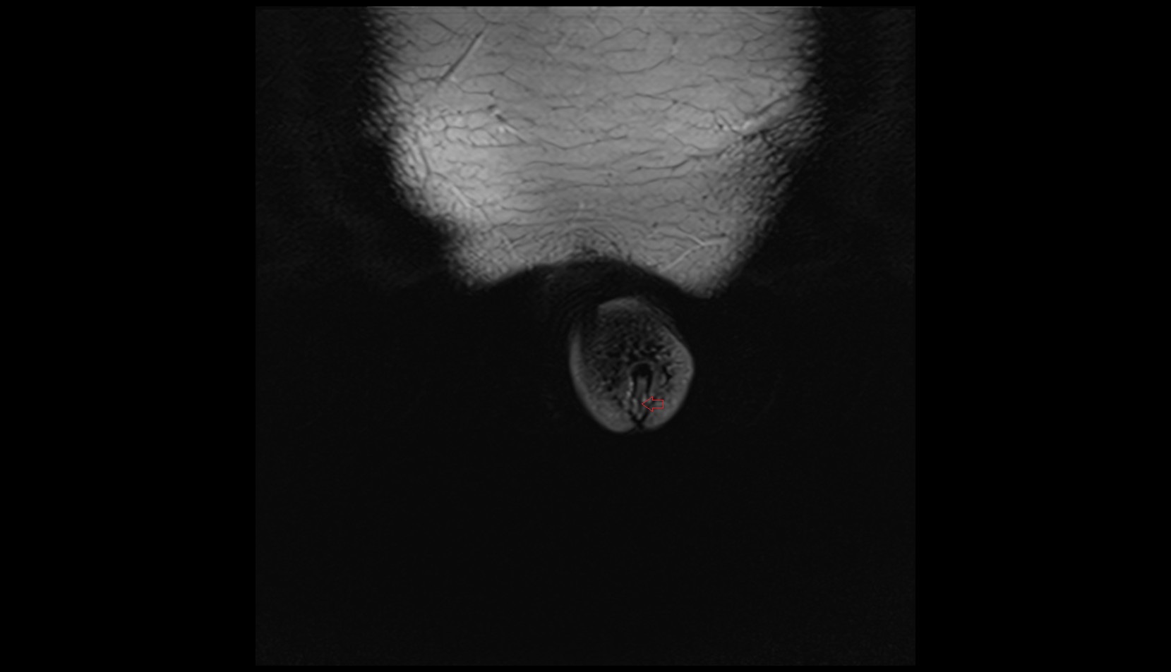 Meatus of the urethra   mri  axial  anatomy  image-img-00000-00000