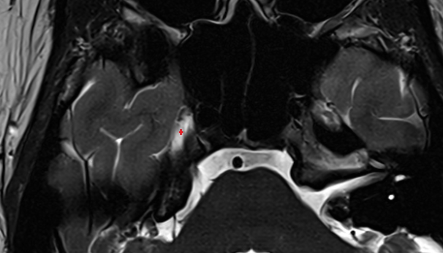 Meckel’s cave (Trigeminal cave) mri axial image -img-00000-00000