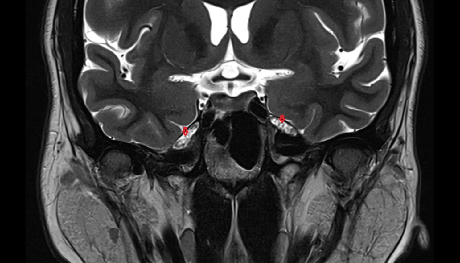 Meckel’s cave (Trigeminal cave) mri coronal image -img-00000-00000