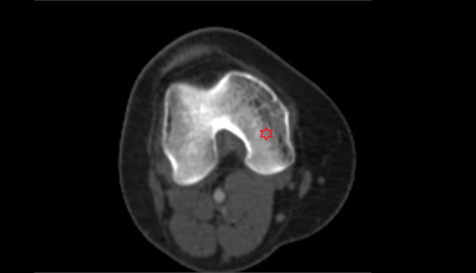 Medial Condyle of Femur ct axial image