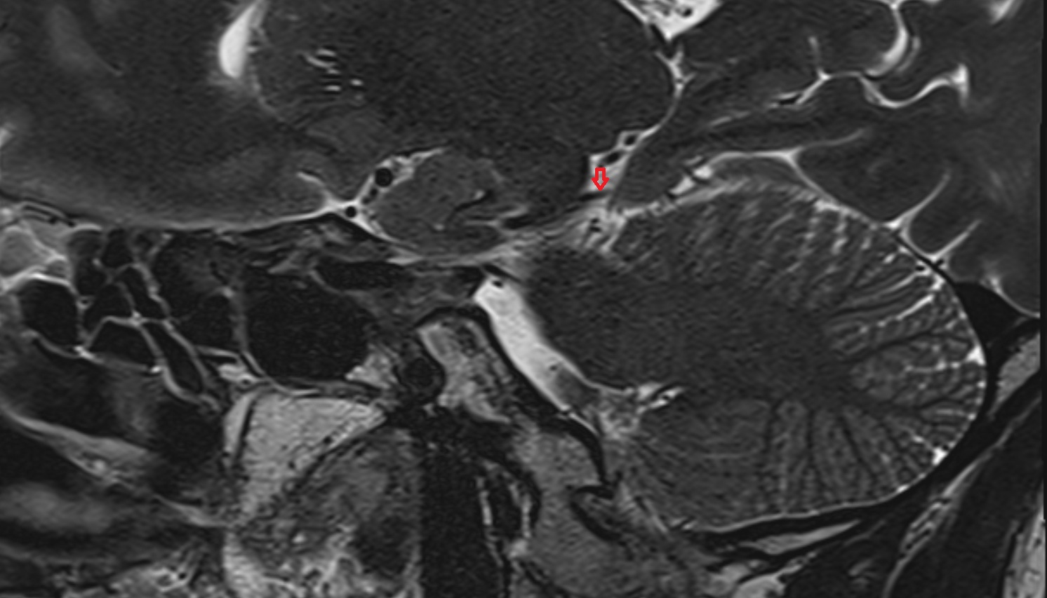 Medial Occipital Artery  mri sag  image -img-00000-00000