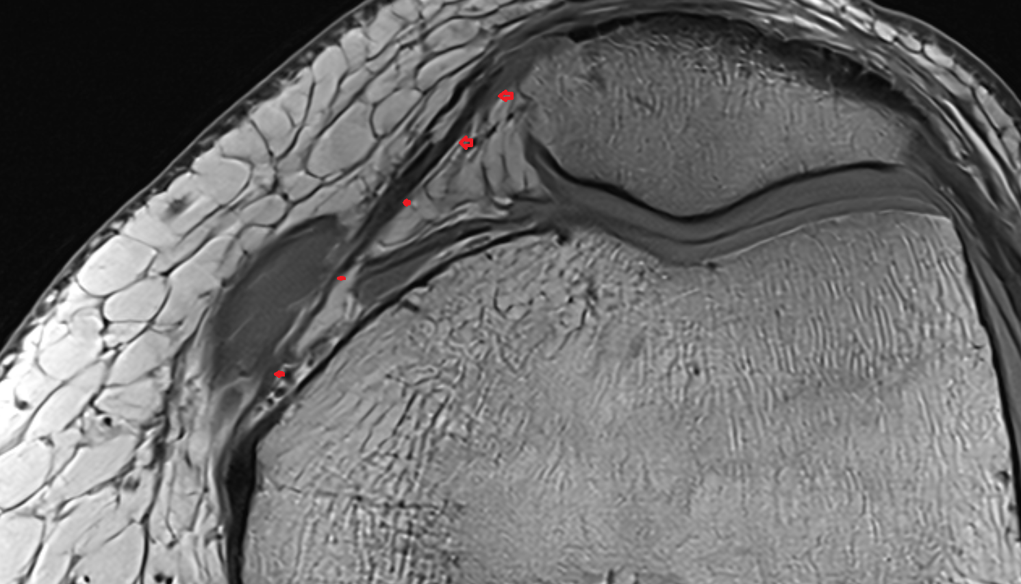 Medial Patellofemoral Ligament (MPFL) axial   cross sectional anatomy 3T MRI AI enhanced  radiology  anatomy image-img-00000-00000