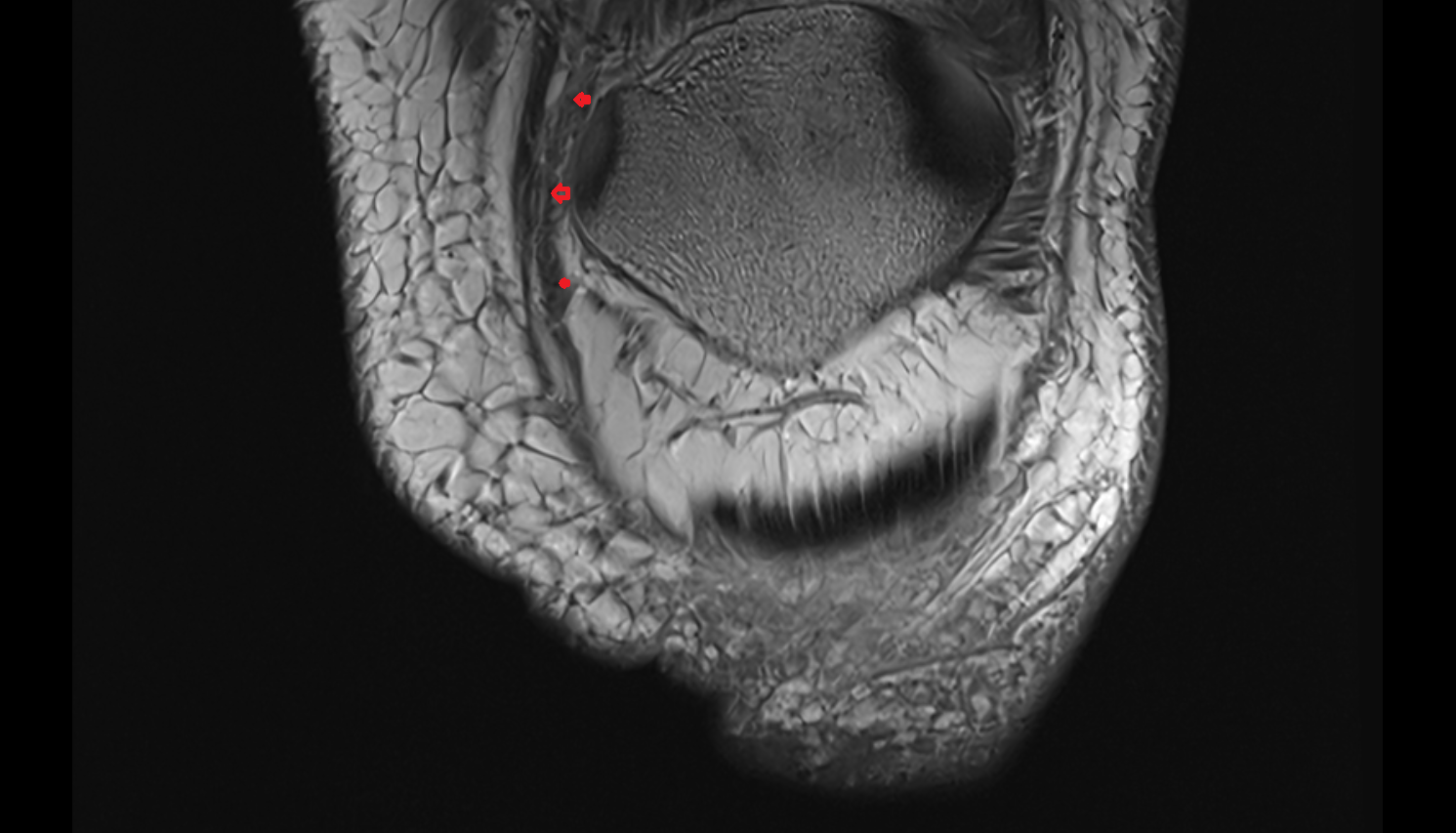 Medial Patellofemoral Ligament (MPFL) coronal   cross sectional anatomy 3T MRI AI enhanced  radiology  anatomy image-img-00000-00000_00001