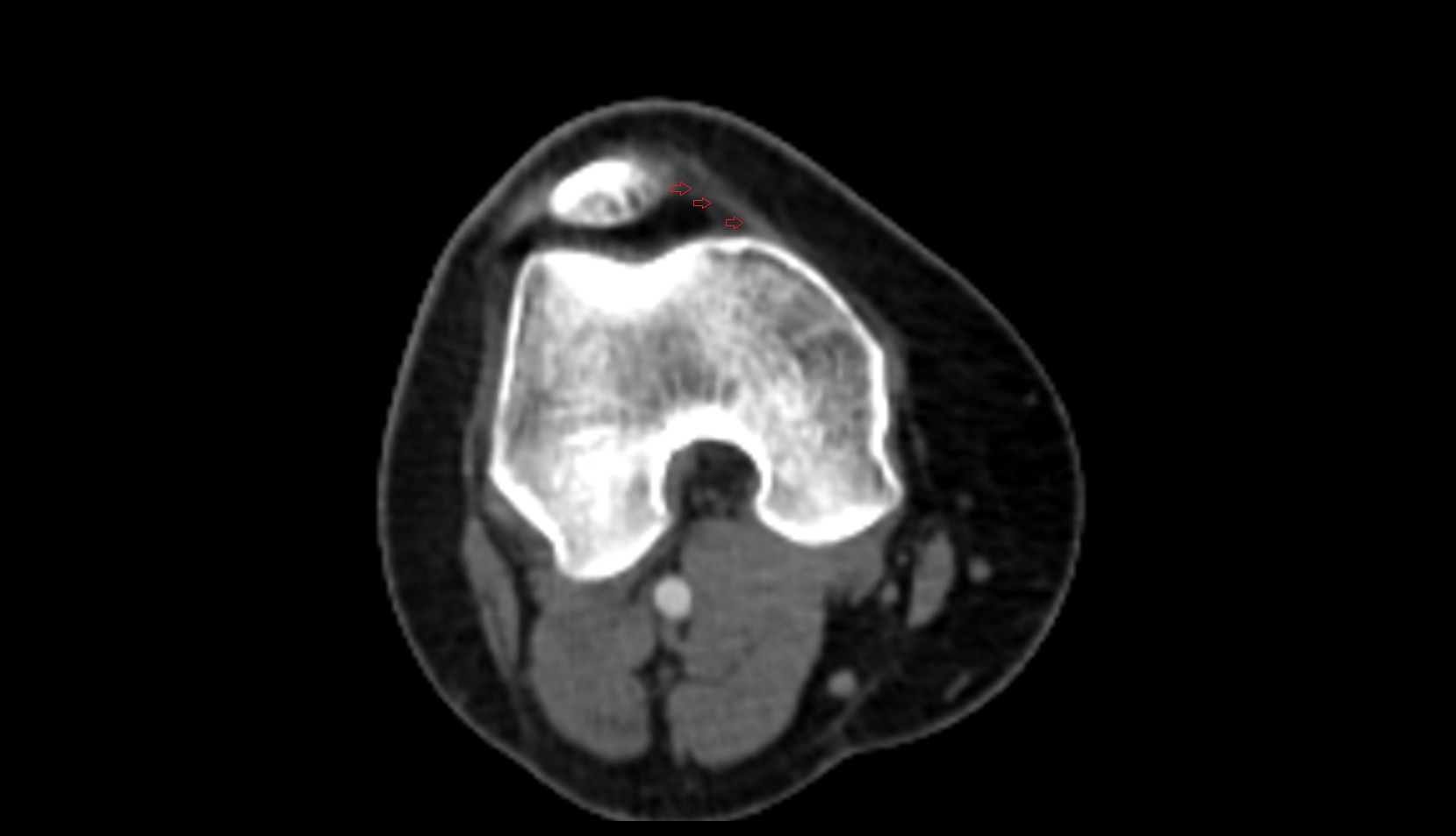 Medial Patellofemoral Ligament (MPFL) ct axial