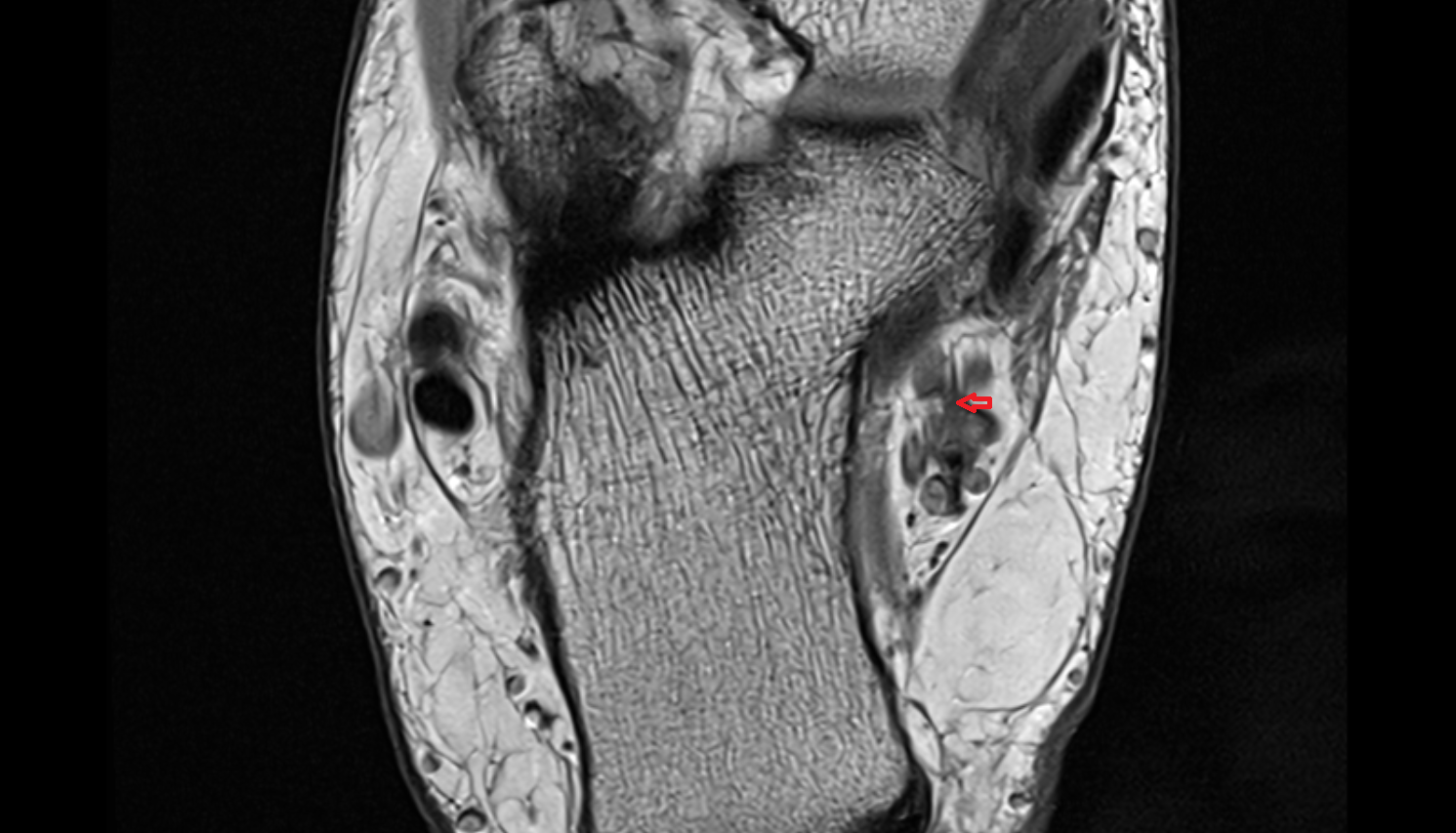 Medial Plantar Artery axial  cross sectional anatomy 3T MRI AI enhanced radiology image-img-00000-00000