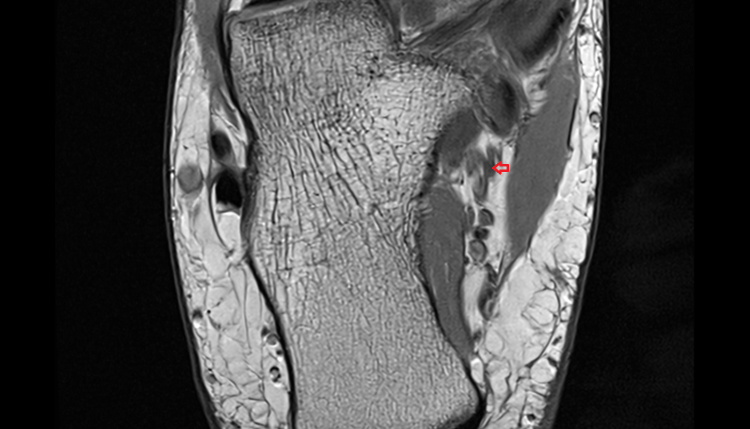 Medial Plantar Artery axial  cross sectional anatomy 3T MRI AI enhanced radiology image-img-00000-00000_00001