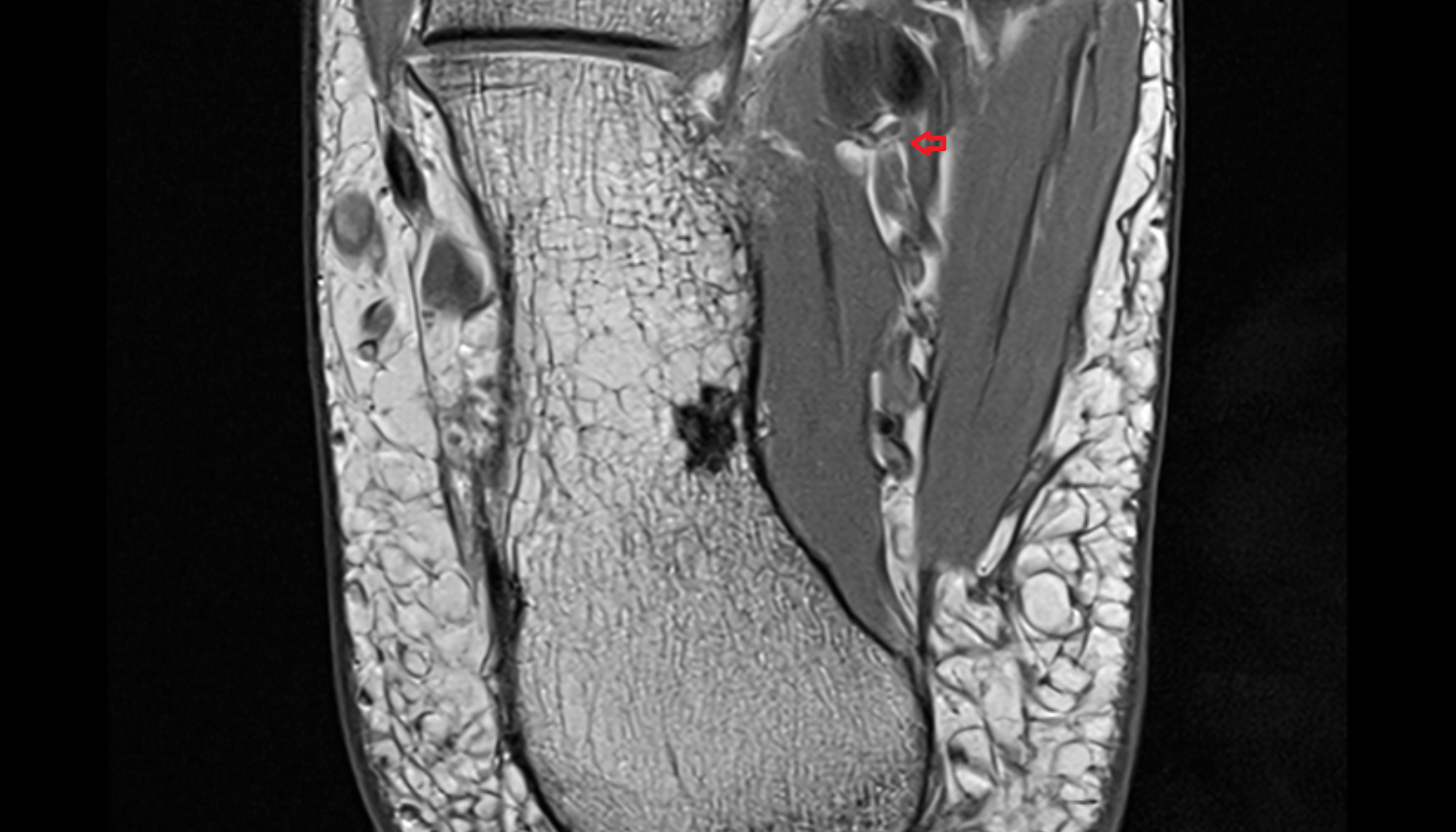 Medial Plantar Artery axial  cross sectional anatomy 3T MRI AI enhanced radiology image-img-00000-00000_00002