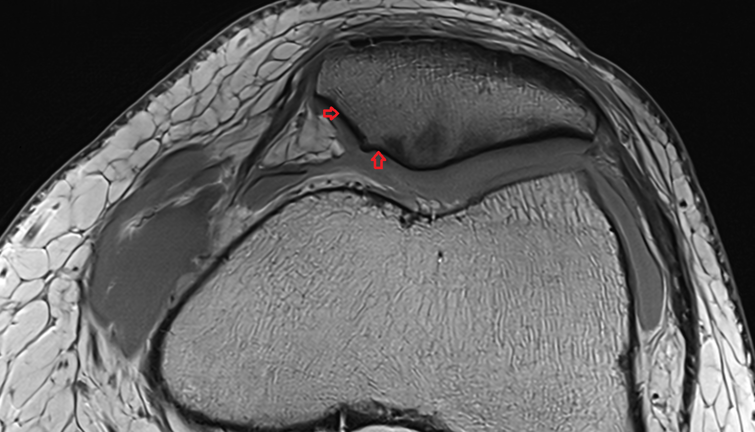 Medial articular facet of patella coronal cross sectional anatomy 3T MRI AI enhanced  radiology  anatomy image-img-00000-00000