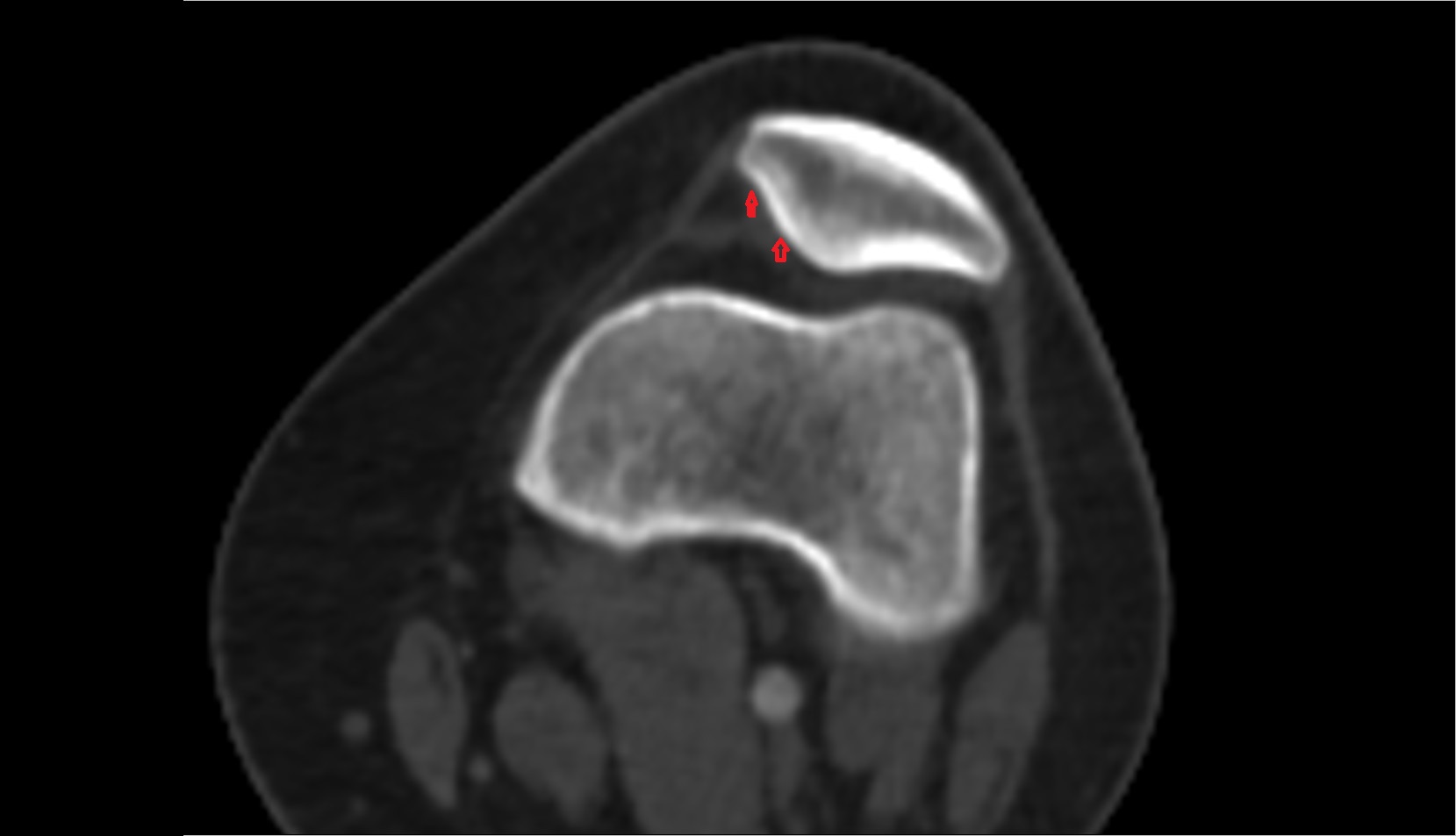Medial articular facet of patella ct axial