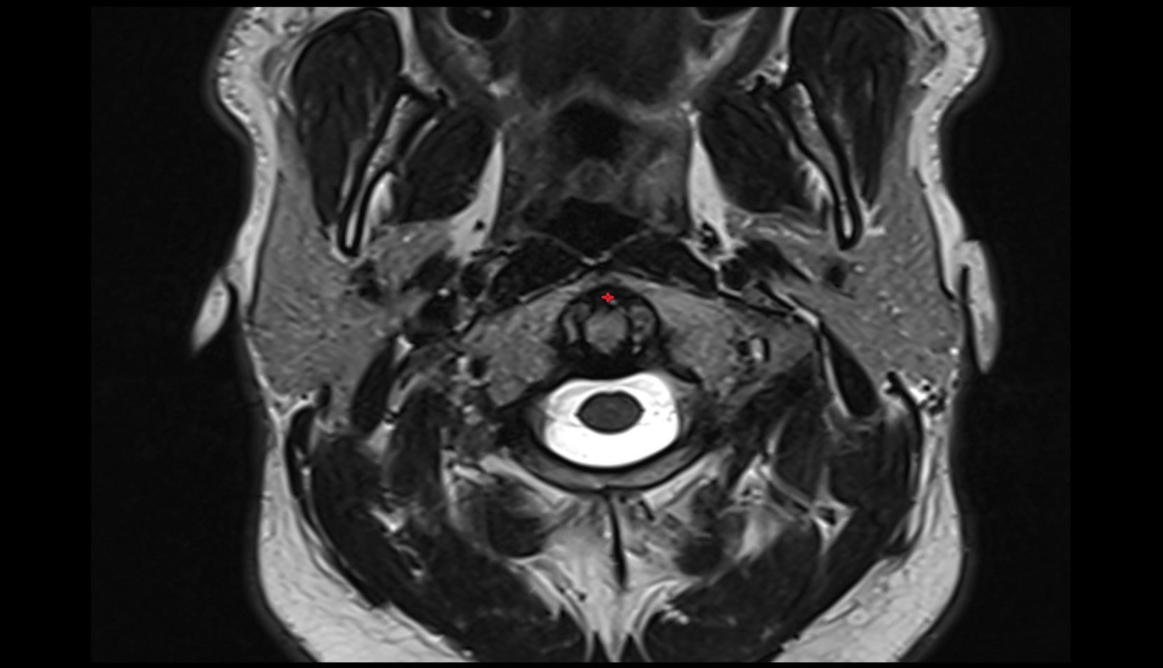 Medial atlantoaxial joint MRI axial image