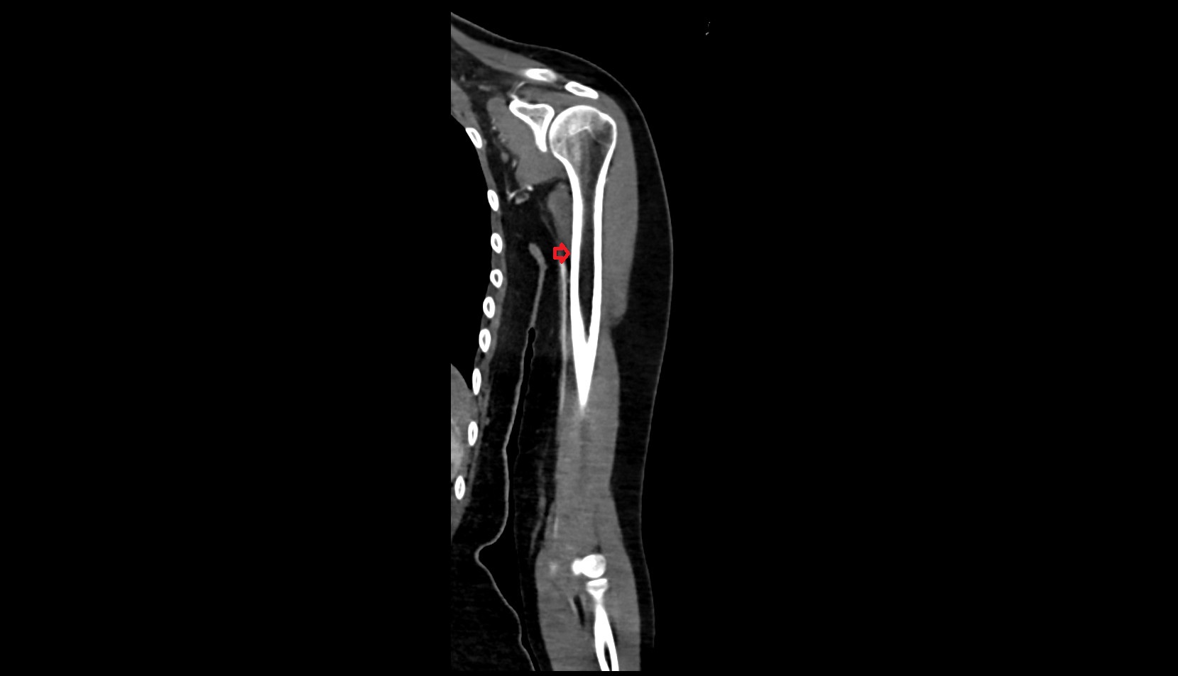 Medial border of humerus ct