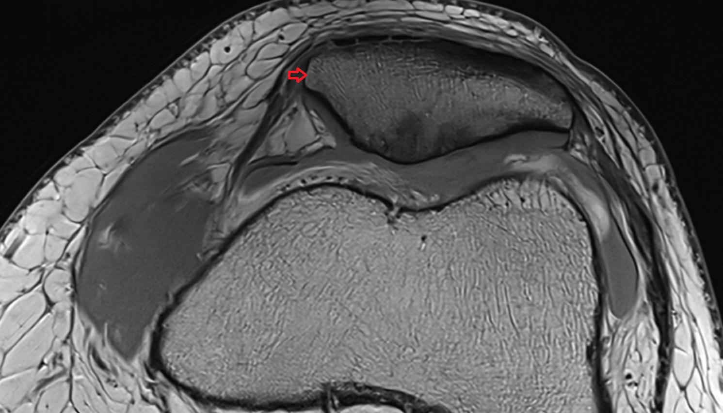 Medial border of patella axial cross sectional anatomy 3T MRI AI enhanced  radiology  anatomy image-img-00000-00000