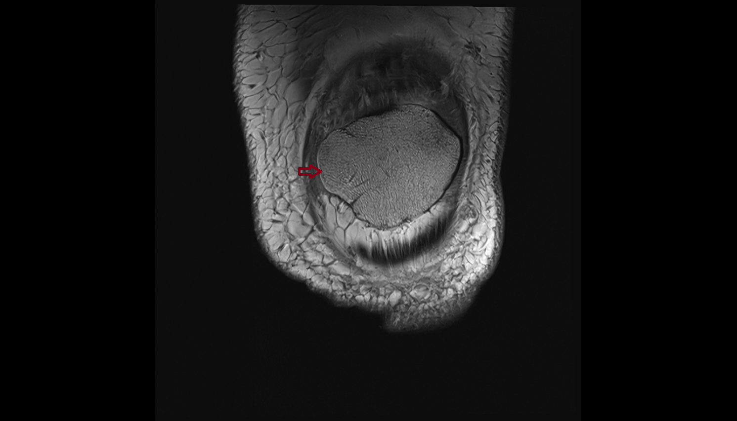 Medial border of patella coronal cross sectional anatomy 3T MRI AI enhanced  radiology  anatomy image-img-00000-00000