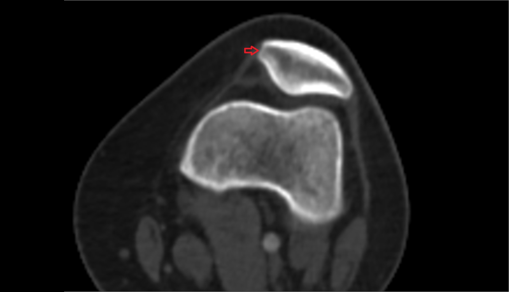 Medial border of patella ct axial