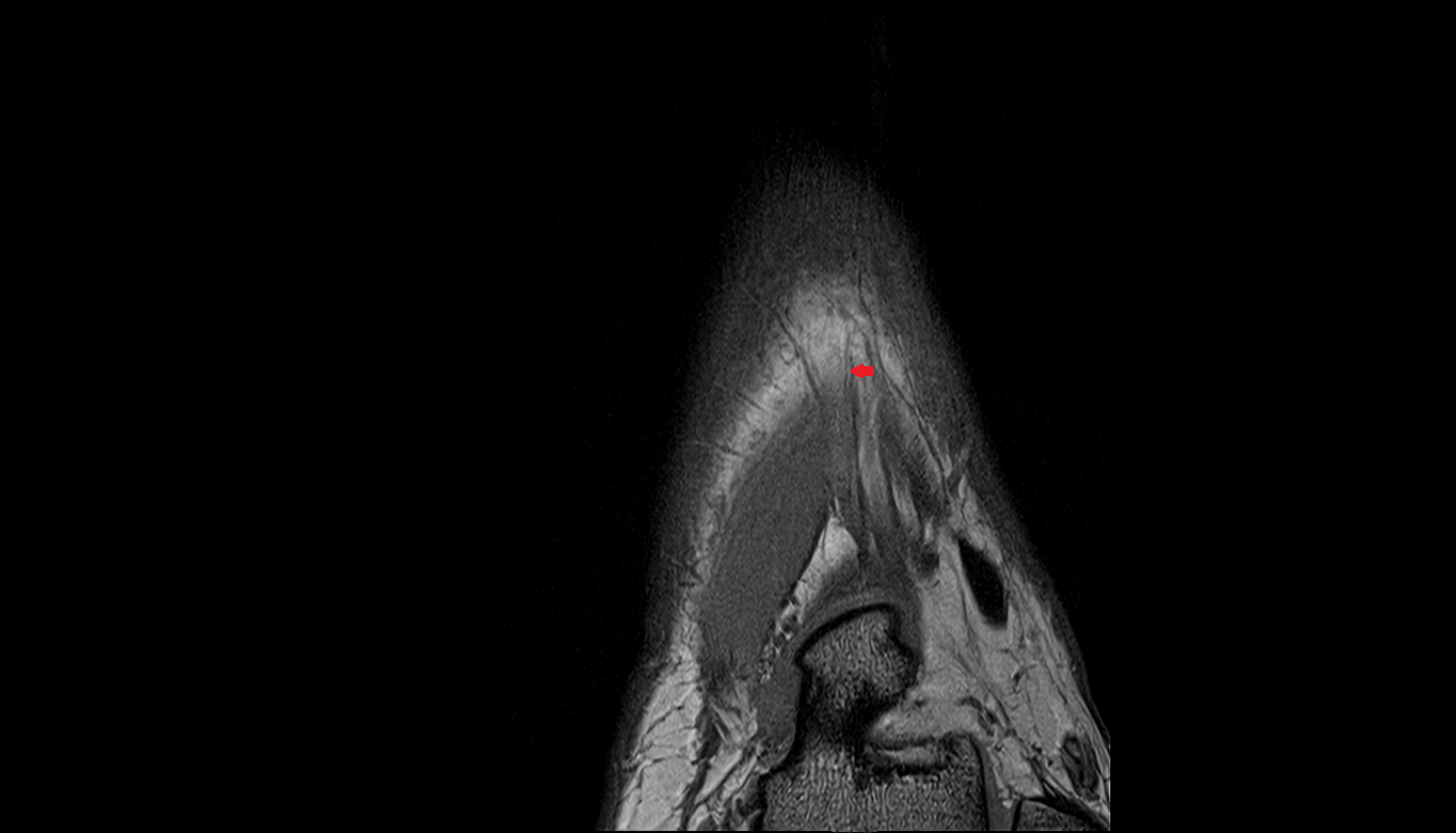 Medial branch of deep fibular nerve coronal cross sectional anatomy 3T MRI AI enhanced radiology image-img-00000-00000