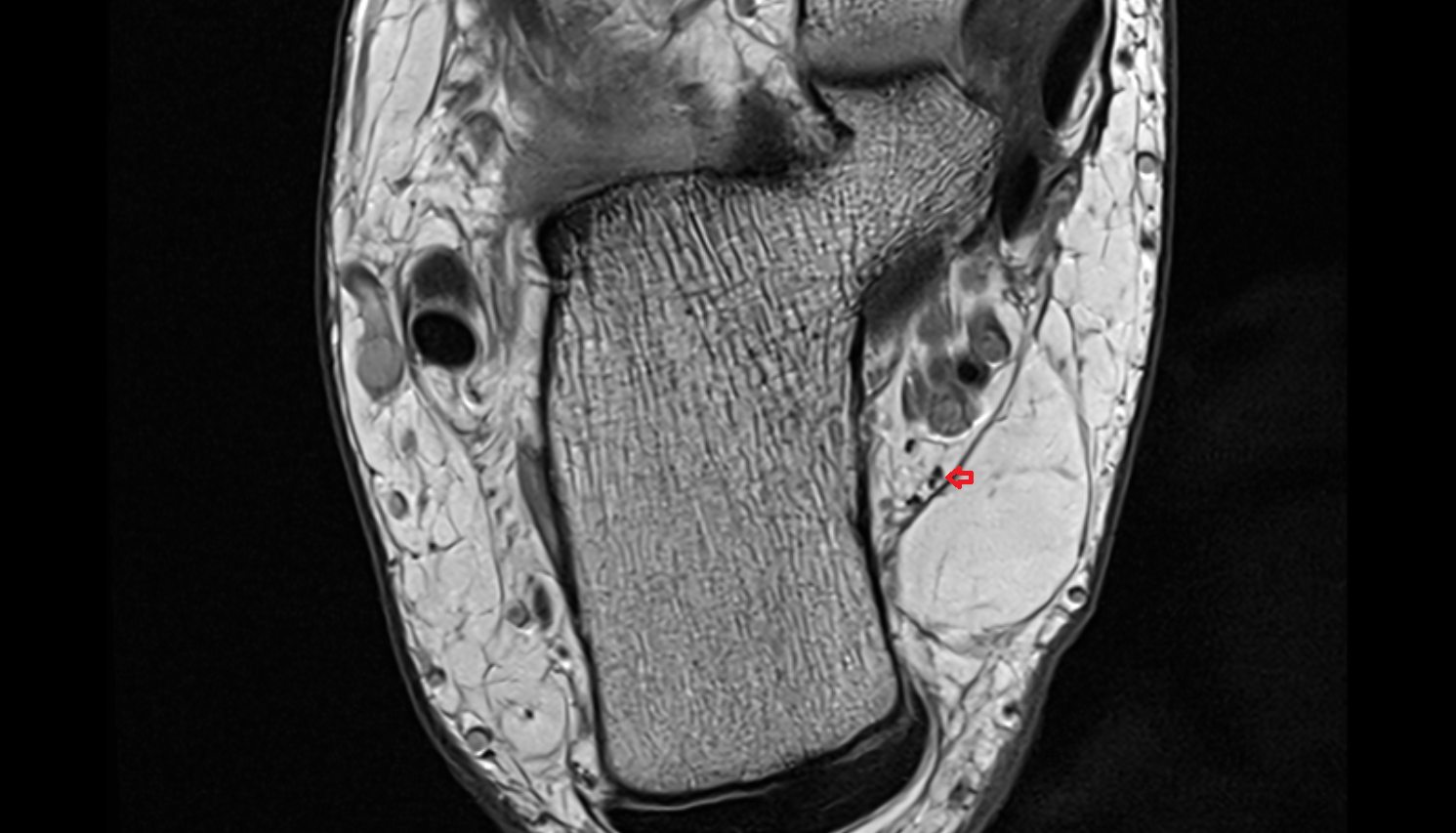 Medial calcaneal nerve (anterior cutaneous branches) axial cross sectional anatomy 3T MRI AI enhanced radiology image-img-00000-00000