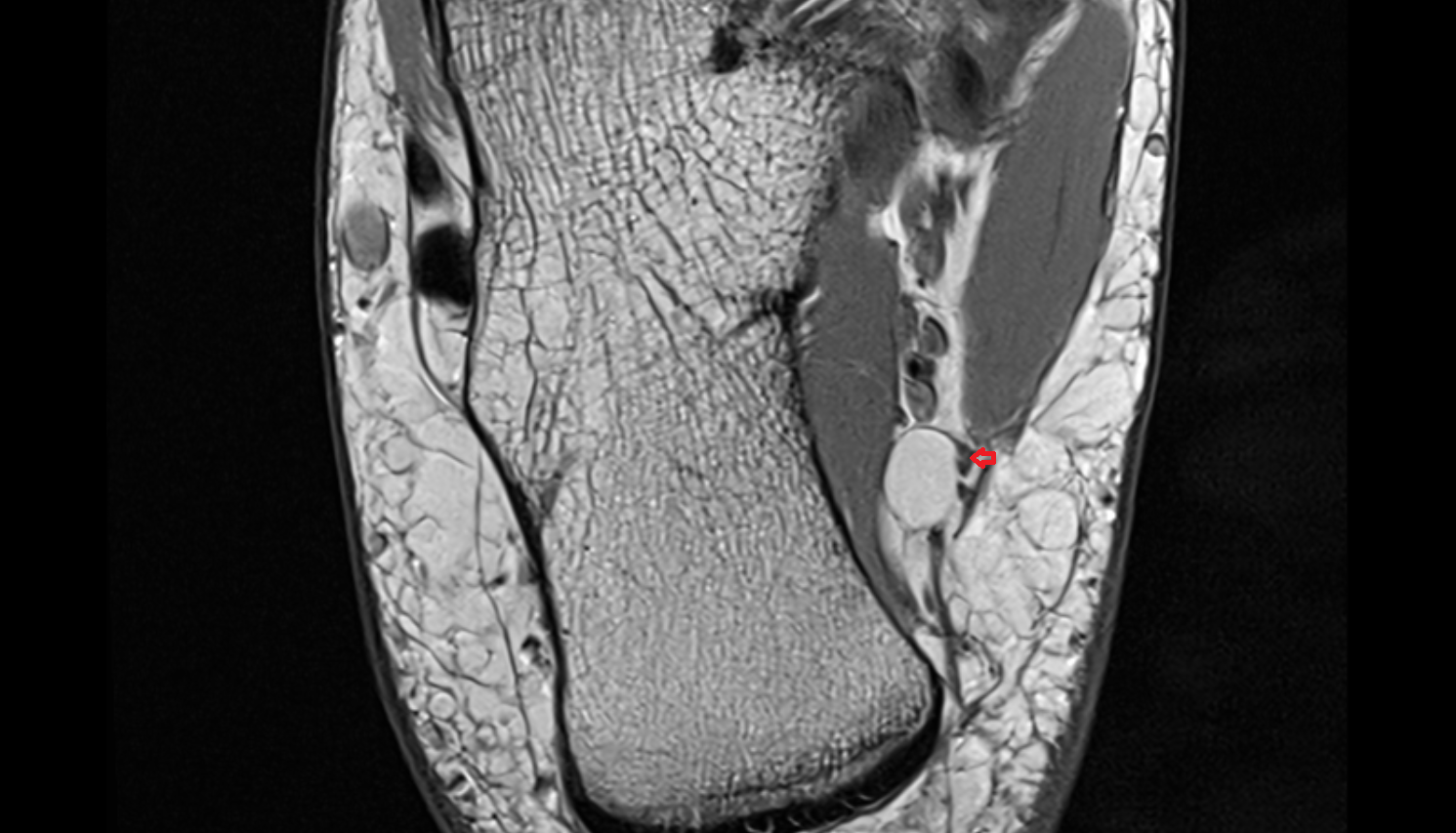 Medial calcaneal nerve (anterior cutaneous branches) axial cross sectional anatomy 3T MRI AI enhanced radiology image-img-00000-00000_00001