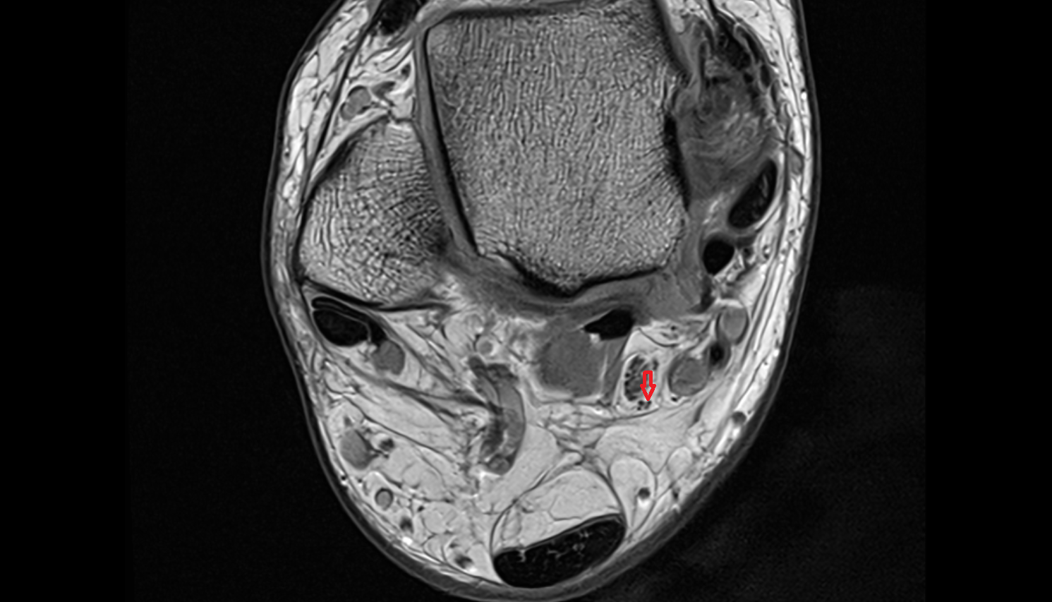 Medial calcaneal nerve  axial cross sectional anatomy 3T MRI AI enhanced radiology image-img-00000-00000